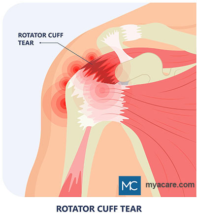 Injured shoulder showing a Rotator Cuff tear which leads to pain and instability in the shoulder complex