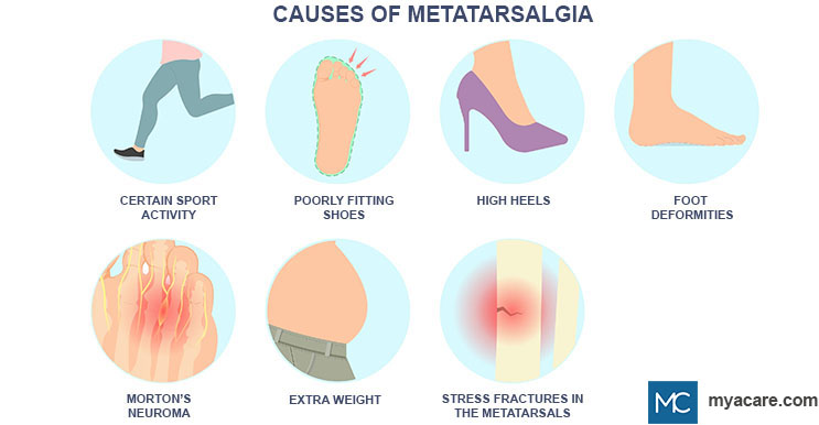 Factors causing Metatarsalgia such as foot deformities,certain sports activities, poorly fitting shoes and high heels