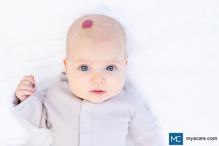 Infantile Hemangioma - red birthmark on the infant's scalp