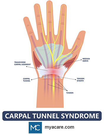 Location of carpal tunnel on the hand