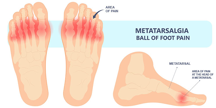 Area of pain at the head of the metatarsal in the ball of the foot - frontal and side view