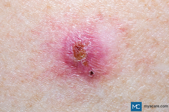 Basal cell carcinoma (BCC) - seen as papules of nodules with ulceration at the center