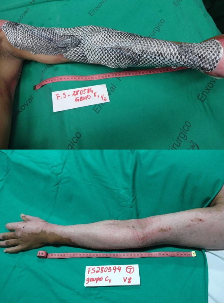 Before and after the application of fish skin for burn wound