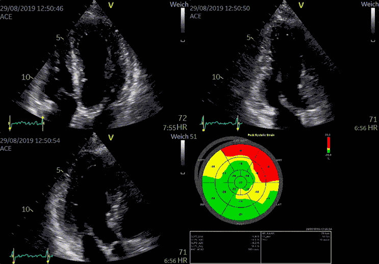Cardiac Imaging depicting Peak Systolic Strain