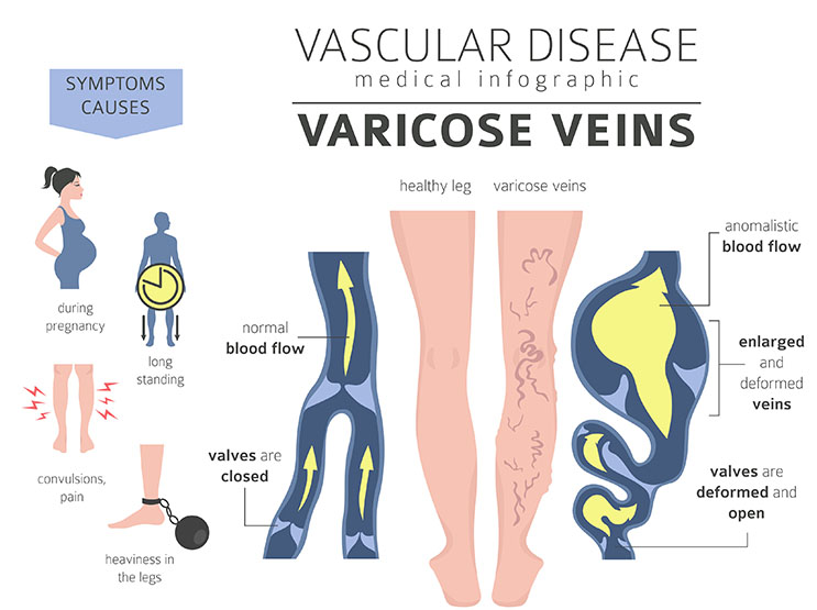 Prolonged standing/ pregnancy causes the leg veins to become enlarged and twisted leading to Varicose Veins