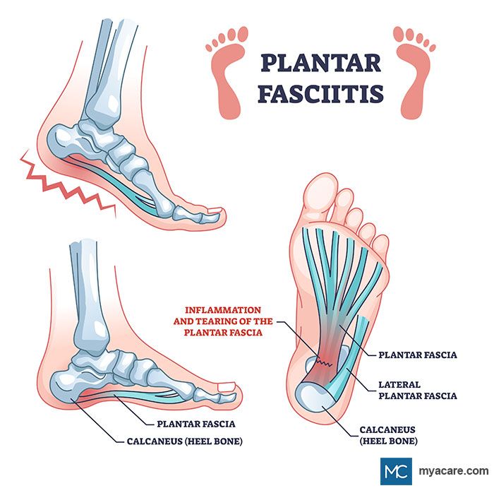 Normal Plantar Fascia,Calcaneus(heel bone) versus Inflammation & tearing of Plantar Fascia,lateral Plantar Fascia,heel bone
