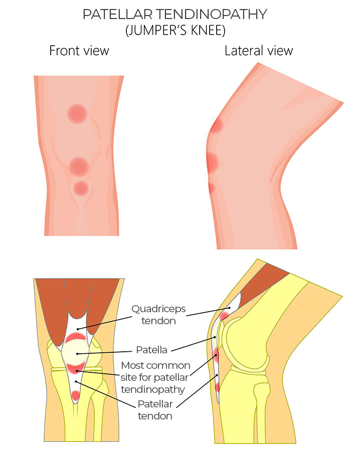 Patellar Tendinopathy(Jumper's Knee): Front&Lateral View,Quadriceps Tendon,Patella,Patellar Tendinopathy site,Patellar Tendon