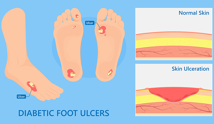 Diabetic Foot Ulcers (left), normal skin layers (top right), skin layers affected by ulceration (Bottom right)