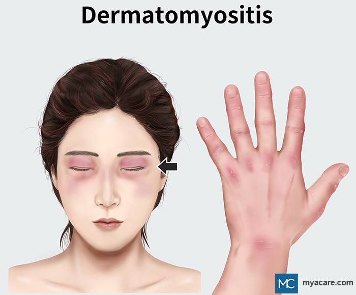 Dermatomyositis - reddish to violaceous patches and plaque around eyes and on the hand