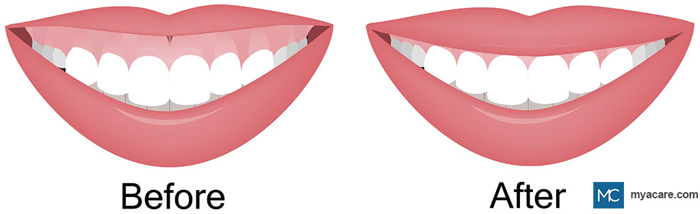 Before(L): Excess display of gums,less display of upper lip when smiling. After(R): Balanced lip & gum display when smiling