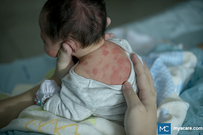Erythema toxicum neonatorum - blotchy, red patches on the back of a baby