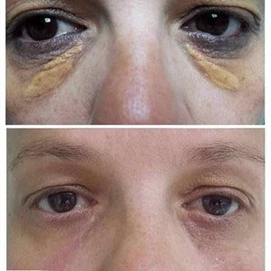 Before and after Plexr Pro treatment for Xanthelasma