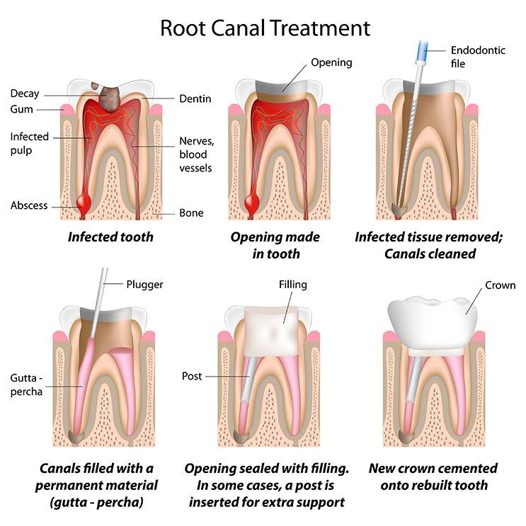 Steps in root canal treatment showing infected tooth, removal of infected tissue, filling of canal, sealing and new crown