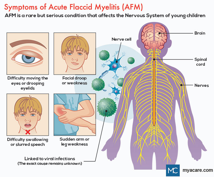 Acute Flaccid Myelitis(AFM)Definition,Symptoms(drooping eye,face droop,speech,swallowing,weakness),Nerve Cell,nervous system