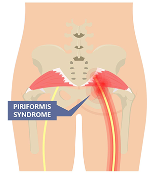Piriformis muscle compressing the Sciatic nerve as it passes underneath