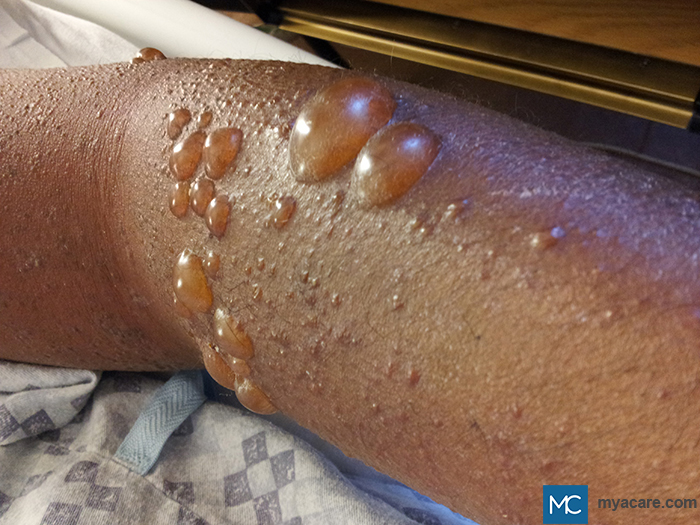 Bullous Pemphigoid (BP) - itchy tense blisters filled with serous fluid seen on the arm