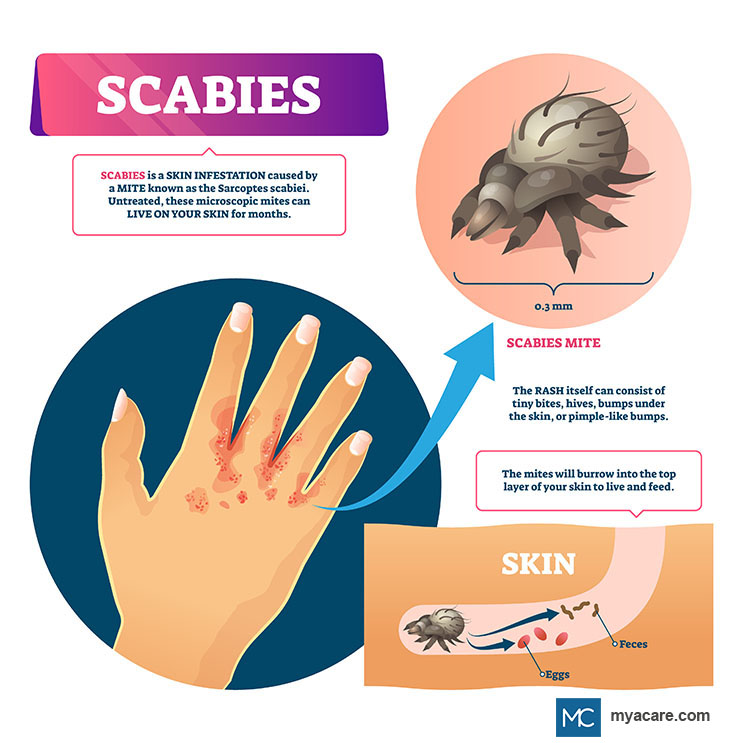 Scabies mite burrows into the skin causing rash-like blisters or pimples with raised bumps filled with fluid on the skin