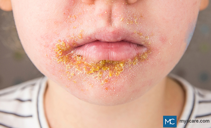 Impetigo - plaques with honey-colored crusts around the nose & lips due to rupture of fluid-filled vesicles