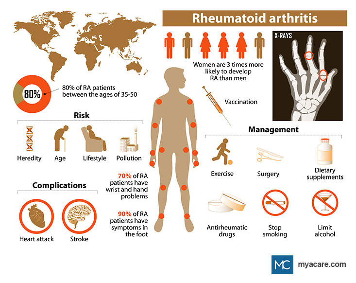 Rheumatoid Arthritis - Statistics, Risk Factors, X-ray of affected hand, Complications, Affected joints, Management 