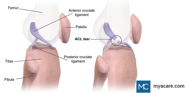 Normal knee joint (left), knee joint with ACL tear (right)