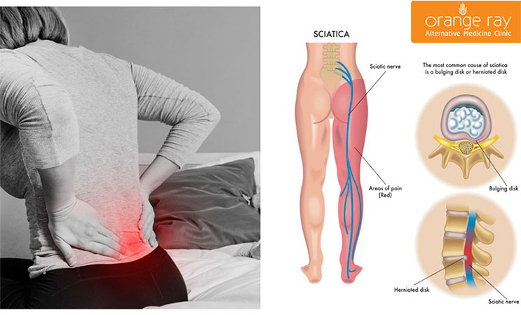 Lower back pain (left), herniated disc compressing the sciatic nerve and causing pain in the lower back, buttock and leg (right)