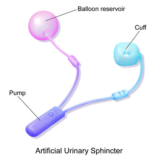 Three-piece artificial urinary sphincter showing the balloon reservoir, cuff and pump