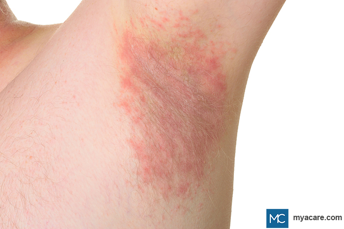 Erythrasma - reddish-brown patches in the armpit