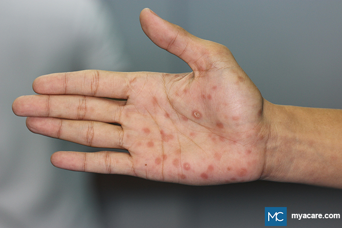 Secondary Syphilis - red to copper-colored macules or papules on the palm