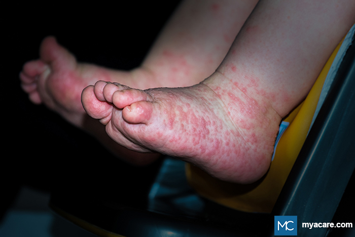Hand-Foot-Mouth disease - bright pink dots and raised lesions on the feet and soles