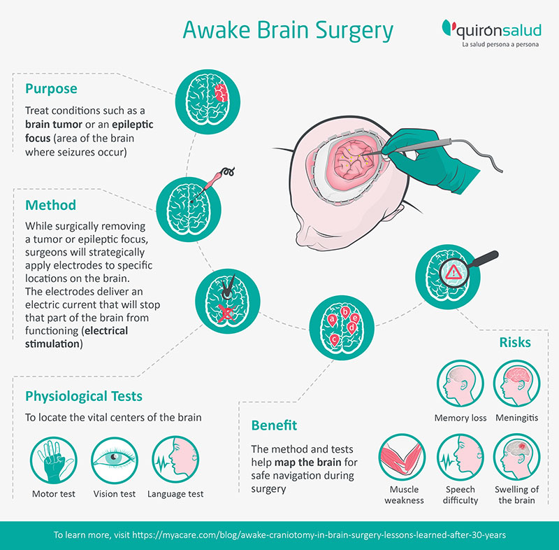 Awake Brain Surgery: Purpose(brain tumor/epileptic focus),Method,Physiological tests(vision, motor, language),Benefits,Risks  - length is 125 characters