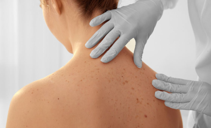 GET RID OF BACK ACNE WITH THESE SIMPLE STEPS
